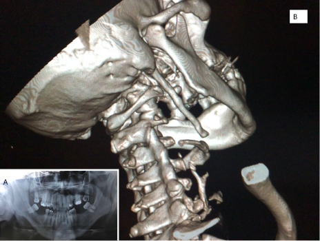 1A. Imagen de radiografía panorámica de maxilares con apófisis estiloides bilateral. 1B. Scan 3D tomográfico con la apófisis que llega al hioides