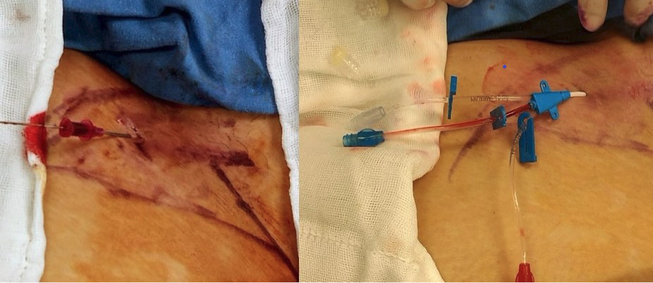 Izquierda, una vez obtenido el flujo venoso, se introduce la guía metálica en la aguja de punción. Derecha, 
			  el catéter femoral colocado, se verifica la permeabilidad del mismo.