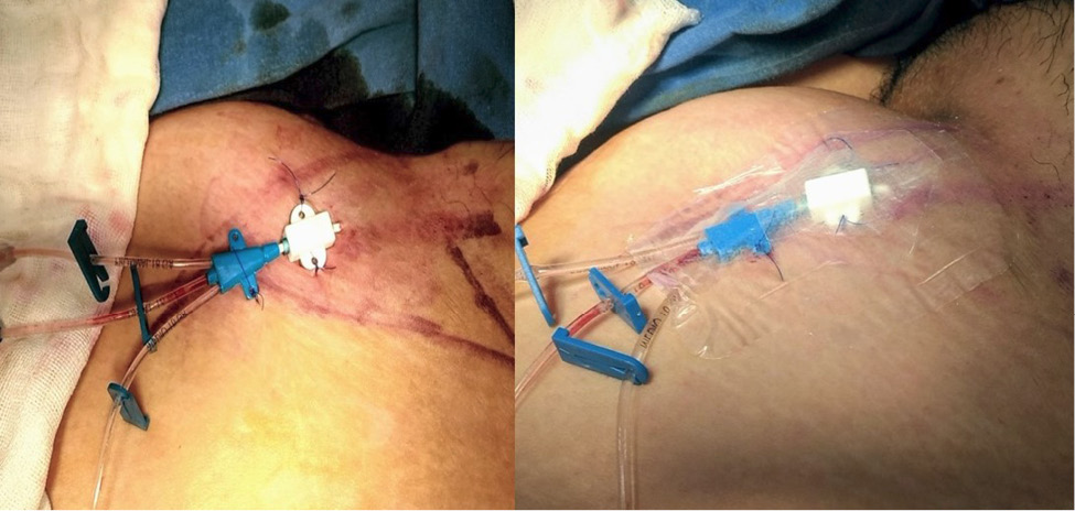 Izquierda, el catéter femoral fijado a piel con sutura no absorbible. Derecha, aislamiento del catéter con 
		    plástico adhesivo estéril.