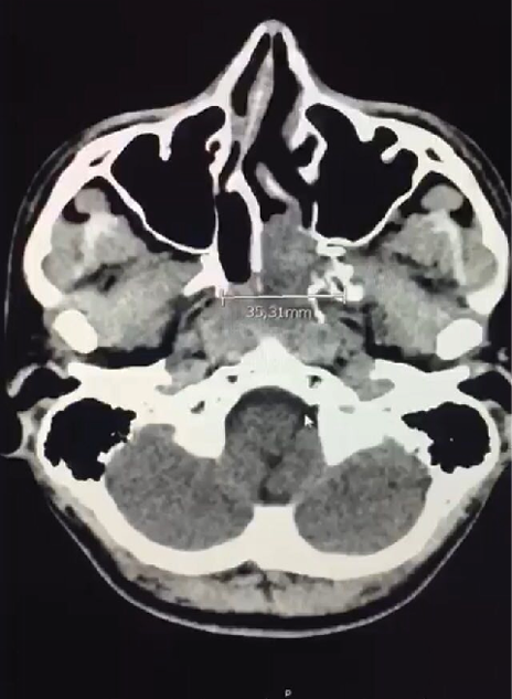 Tomograf&iacute;a axial computarizada con lesi&oacute;n expansiva en fosa pterigomaxilar izquierda. 