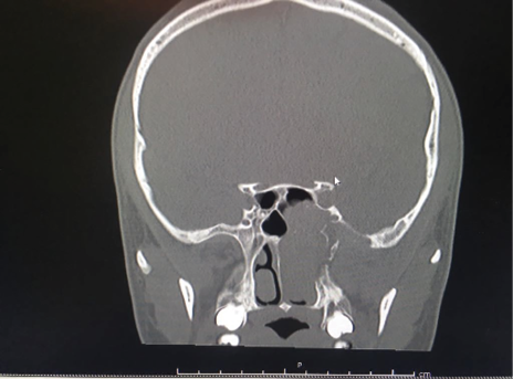 Tomograf&iacute;a Axial Computarizada, Corte coronal. Fuente: Hospital Militar Central de Bogot&aacute;.