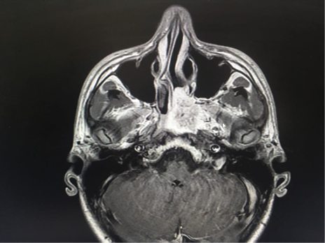 Resonancia Magn&eacute;tica Senos paranasales T1.