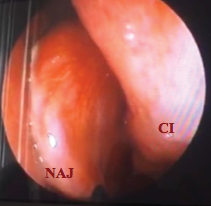 NAJ Nasoangiofibroma Juvenil. CI[Cornete inferior]