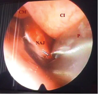 NAJ[Nasoangiofibroma Juvenil], CI[Cornete inferior], CM [Cornete Medio], P [Pinza de Biopsia].
