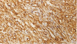 CD34 reactivo en pared de estructuras vasculares [x400].