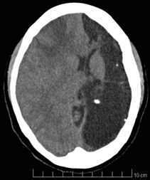 TC cerebral de corte sagital.