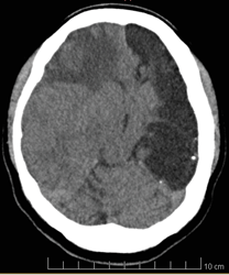 TC cerebral corte sagital.