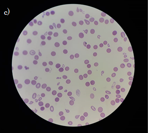  Extendido de sangre donde se observa la morfología de los eritrocitos en β-alasemia