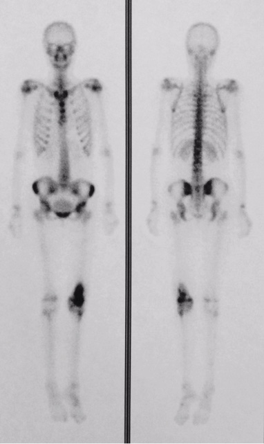  Bone scintigraphy &ndash; focal area of increased  heterogeneous uptake in the distal metadiaphyseal area of the left femur with a highly  aggressive osteoblastic lesion