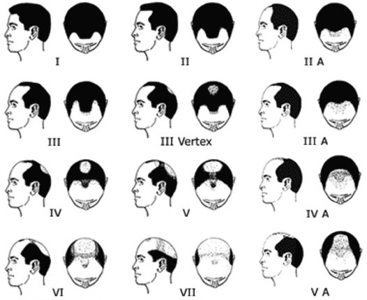 Escala Hamilton-Norwood para alopecia masculina