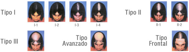 Escala de Ludwig para alopecia androg&eacute;nica en mujeres