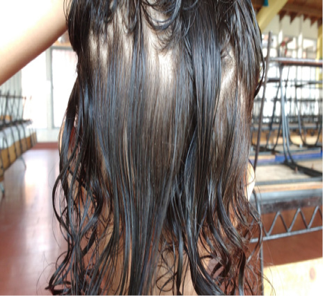 Multiple nits (eggs) on hair