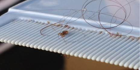 Louse and nits in lice comb.