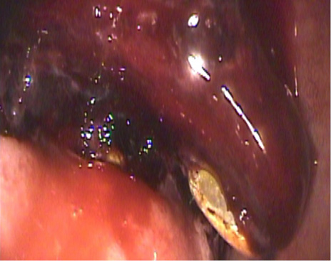 Se observa el coágulo adherido al lecho de la úlcera (clasificación Forrest IIb).