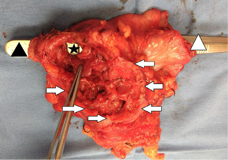 Se muestra la pieza quirúrgica resecada. Triángulo negro la primera porción del duodeno, triángulo blanco el antro pilórico, estrella negra el sitio de fístula colecistoduodenal, las flechas blancas muestran el borde de la pared de la vesícula biliar.