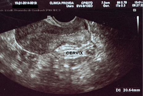 Longitud c&eacute;rvix uterino por ecograf&iacute;a transvaginal