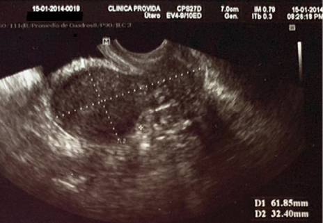 Longitud de &uacute;tero por ecograf&iacute;a transvaginal