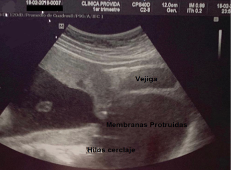 Membranas protruidas en vagina