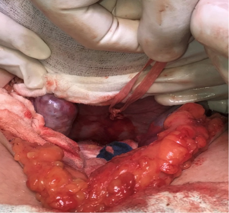 Cerclaje abdominal cara posterior de regi&oacute;n istmo cervical