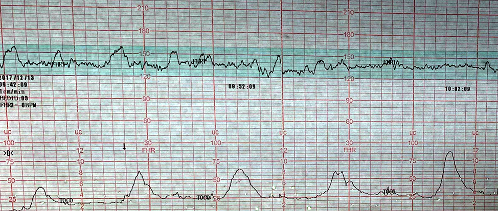 Monitoreo fetal electr&oacute;nico 
