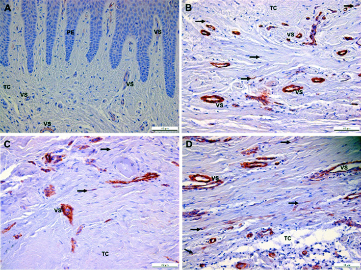 Inmunomarcaje de Expresión de α-SMA en tejido gingival de individuo sano (A) y paciente con hipertrofia gingival inducido por tratamiento ortodóntico (B, C, D)