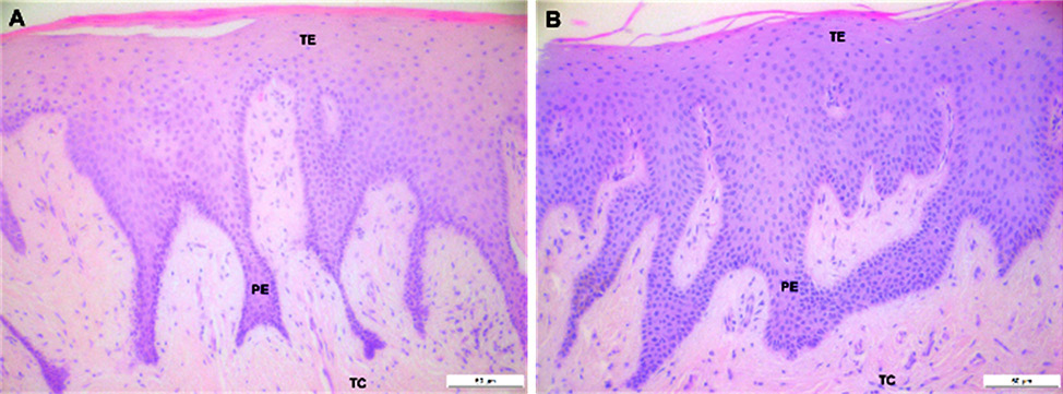  Microfotografía del tejido gingival de individuo sano (A) y paciente con hipertrofia gingival inducida por tratamiento ortodóntico (B)