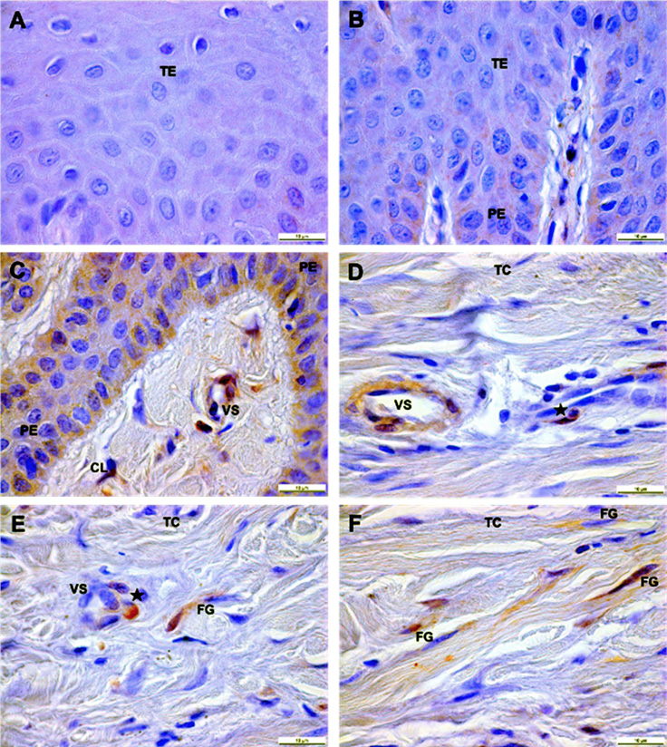 Expresión de S100A4 en tejido epitelial de la encía de individuo sano (A, B) y paciente con hipertrofia gingival inducido por tratamiento ortodóntico (C,D,E,F).