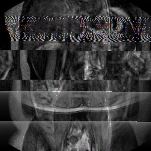Imagen 9. De la serie: Anomala. Data Bending sobre imgenes de RM. (Autor, 2022).