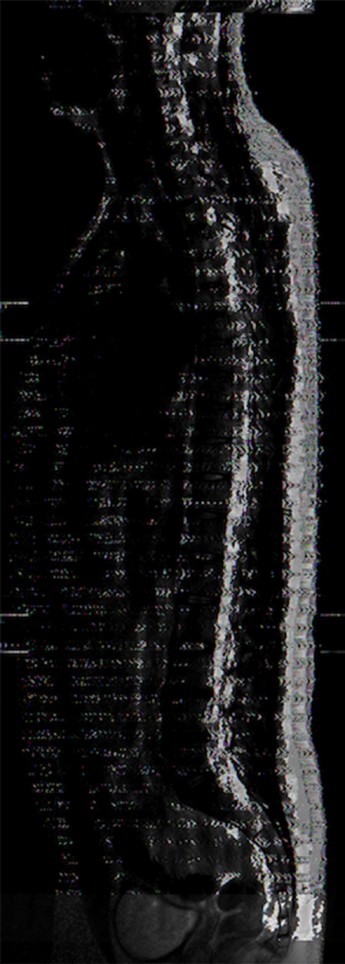 Imagen 13. De la serie: Anomala. Data Bending sobre imgenes de RM. (Autor, 2022).