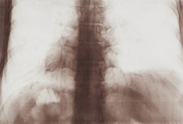 Imagen 5. El dolor de la existencia en imagen de lo real.Radiografa digital. (Autor, 2022).