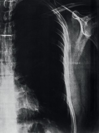 Imagen 6. El dolor de la existencia en imagen de lo real.Radiografa digital. (Autor, 2022).