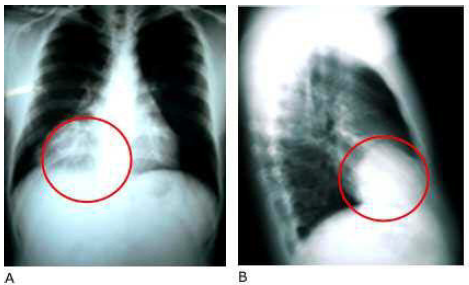 Radiograf&iacute;a de t&oacute;rax posteroanterior (A) y lateral (B), donde se observa una masa homog&eacute;nea de bordes bien definidos, que ocupan el seno cardiofr&eacute;nico derecho.
