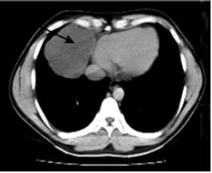 TAC. Imagen de una masa ubicada en &aacute;ngulo cardiofr&eacute;nico derecho, con densidad de 3UH, bien definidas, que mide 8 cm, compatible con quiste cel&oacute;mico del pericardio, de bordes bien definidos, que ocupa el seno cardiofr&eacute;nico derecho.