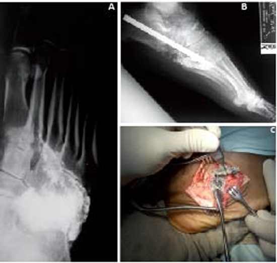 1.caso A. Oblique Projection Radiography: Fragments of lead level Chopart and Lisfranc joints. B. X-ray of the foot. Oblique. Autografts column and osteosynthesis fixing the sidebar. C. Lateral approach to the midfoot. Extraction of lead fragments