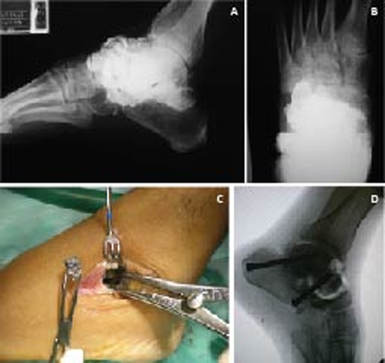 Case 2: A. AP radiograph. Commitment severe subtalar and Chopart joint by gun fire. B. AP radiograph. Commitment severe subtalar and Chopart joint by gun fire. C. subtalar approach. Removing Projectiles and intraarticular fragments lead. D. Lateral Ankle radiograph. Subtalar arthrodesis with compression screws. Liberation Talo-Navicular joint and autografts