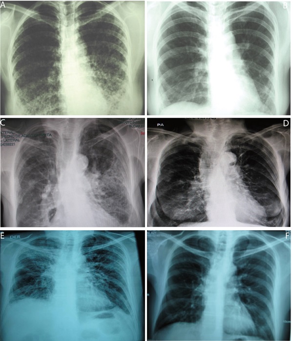 Chest X-ray of 3 patients. A and B: Chest X-ray of patient 1, December 2001 and July 2003 before and 22 months after ganciclovir treatment end, respectively. C and D: Chest X-ray of patient 5, April 2010 and September 2010, before and two months after ganciclovir-vaganciclovir treatment end, 4 months after trimethoprin sulfamethoxazole treatment end and 1 month after voriconazol treatment end, respectively. E and F: Chest X-ray of patient 6, November 2009 and February 2010, before and two months after trimethoprin sulfamethoxazole end and at ganciclovir treatment end, respectively.