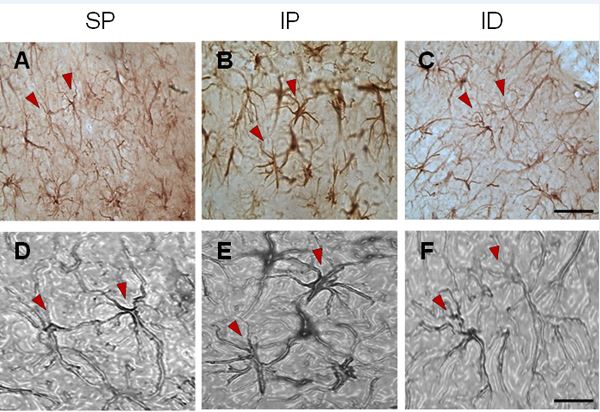 Representative microphotographs of astrocytic reactivity in the hippocampus of rats subjected to multifocal ischemia by arterial embolization and the effect of DMSO. A) Field with typical astrocytes from the sham + placebo group (SP) apparently normal, characterized by thin cell bodies and long, highly branched cytoplasmic processes. B) Astrocyte types from the ischemia + placebo (IP) group with shortening of cytoplasmic projections, thickening of the cell body and evident increase in internal density, and morphological changes characteristic of post-ischemic astrocytic hyper-reactivity process. C) Astrocyte types from the sub-granular zone of the hippocampus following treatment with DMSO in which long cytoplasmic projections, thin, highly-branched cell bodies were observed similar to the control group (SP).D, E and F correspond to plasticized images, magnified and in a gray scale that were obtained from the original photographs (A, B and C) respectively. The arrowheads show typical astrocytes in each of the states: normal (A and D), hyper-reactive characteristic of ischemia (B and E) and recovered from treatment with DMSO (C & F). Scale bar of C = 50 microns for the pictures in the upper row and 20 microns in F for images in the lower row.
