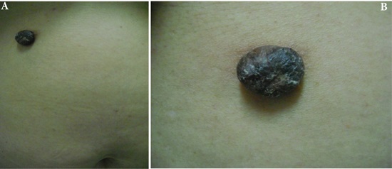 A and B. Hyperpigmented, hyperkeratotic nodule on abdominal skin. lesion Appear to be 0.5 mm long x 0.3mm wide in size
