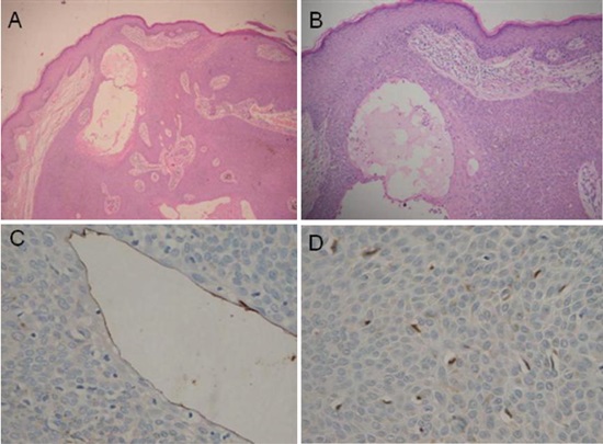 Hematoxylin and eosin staining, 10X and 40 x; Instrument Olimpus. Panel A and B are 10 x amplification, C and D are 40 x amplification. note proliferation of small keratinocytes emerging from the epithelium with epithelial tracts that anastomose within the dermis, some cavities lined by a eosinophilic cuticle (A,B), Carcinoembryonic Antigen (CEA) highlights positive in the elongated cells lining the cavities (C), the S100 marker is observed in dendritic cells and keratinocytes in the thickness of the cell proliferation (D).
