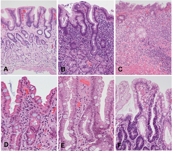Correa's precancerous cascade. A, Normal gastric mucosa. B, Non atrophic chronic gastritis. Abundant inflammatory infiltrate in lamina propria with well-preserved glands observed in the deeper half of the mucosa. C, Multifocal atrophic gastritis without intestinal metaplasia. Marked loss of glands, with prominent inflammatory infiltrate and proliferation of fibrous tissue in the lamina propria. D,Intestinal metaplasia, complete type. Goblet cells alternating with absorptive enterocytes that present well-developed brush border. E, Intestinal metaplasia, incomplete type. Goblet cells alternating with columnar cells that contain mucin droplets of variable sizes. F, Dysplasia. Epithelium with high-grade dysplasia (lower half of the photograph) occurring in a background of incomplete metaplasia (observed in the foveolar superficial  epithelium). (H&E; original magnification: A-C x100; D-F x200).Images A-Care reproduced with permission reference 60.
