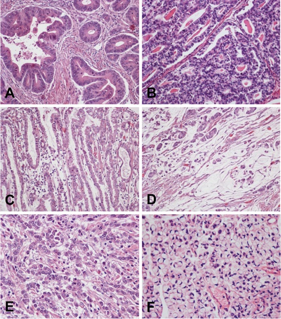 Gastric adenocarcinoma. A-C, Intestinal type. Three different tumors are shown with formation of irregular glands, tubules and papillae. D, Mucinous adenocarcinoma, with small groups of tumor cells floating in pools of mucin. E y F, Diffuse type. Two different tumors are shown composed of non cohesive individual cells infiltrating the stroma. Signet ring cell carcinoma (F) is formed by cells with abundant intracytoplasmic mucin and nuclei displaced to the periphery. This morphology is characteristic of this tumor type.