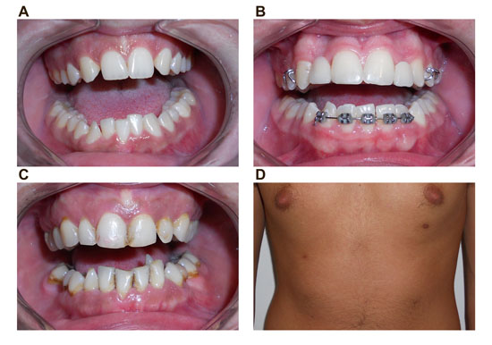  A. Teeth agenesis in the daughter. B. Teeth agenesis and replacement with a removable dental prosthesis in son. C. Dental anomalies in the mother. D. View of supernumerary nipples in the son.