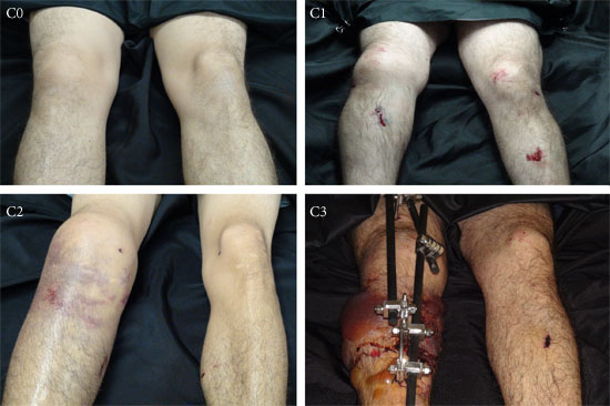 Oestern and Tscherne Classification. C0: Little or no injury to the soft tissues with simple fractures caused by indirect trauma. C1: Surface abrasions or contusions of the skin associated with simple or medium complexity fracture lines; these injuries are usually caused by the pressure exerted by the bone fragments on the soft tissue. C2: Deep contaminated abrasions and contusions in the skin and muscle resulting from direct trauma. Imminent compartment syndrome fits into this group. The Associated fracture lines are generally complex. C3: Extensive skin contusion, destruction of muscle or subcutaneous tissue and closed avulsions. Compartment syndrome and vascular lesions are included. The fracture lines are complex.
