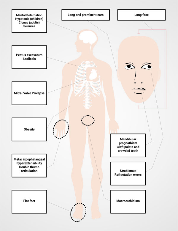  Description of the typical phenotypic characteristics of Fragile X Syndrome.