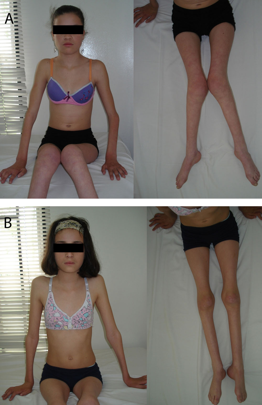 Family tree of the patients. A. Arrow shows patient Case 1. Older sibling is unaffected; however, genetic testing has not been done because of the age of the patient. There are no other known affected members, and carrier status is not available for other family members. B. DNA sequencing results of the patient Case 1, showing Q163X mutation at GDAP1 gene (c.487 C>T). 