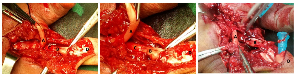 The Flexor Digitorum Profundus (A) and Flexor Digitorum Superficialis (B), with separate sheaths (C) in the palm of hand at zone II region. D shows the base of 4th finger. Normally Each FDS (B) and FDP(A) tendons of fingers runs together among a tendon sheath into the fibro-osseous canal of each digit (D).In this variation the FDP and FDS have separated sheath (C).