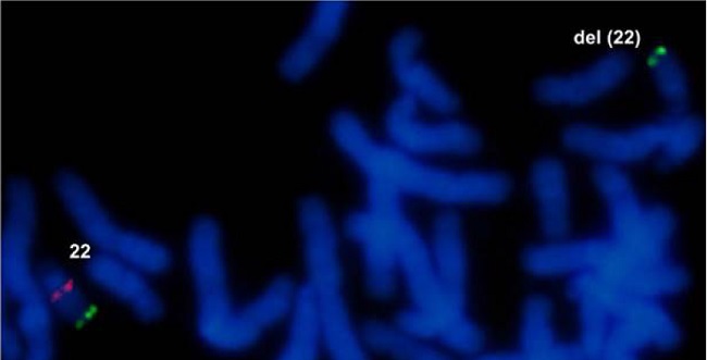 A partial metaphase after FISH with a dual TUPLE1 red spectrum /ARSA green spectrum probe (Vysis®). The normal 22 chromosome had red and green signals meanwhile the deletion 22q11.2 chromosome lacked the red signal and had only the green one.