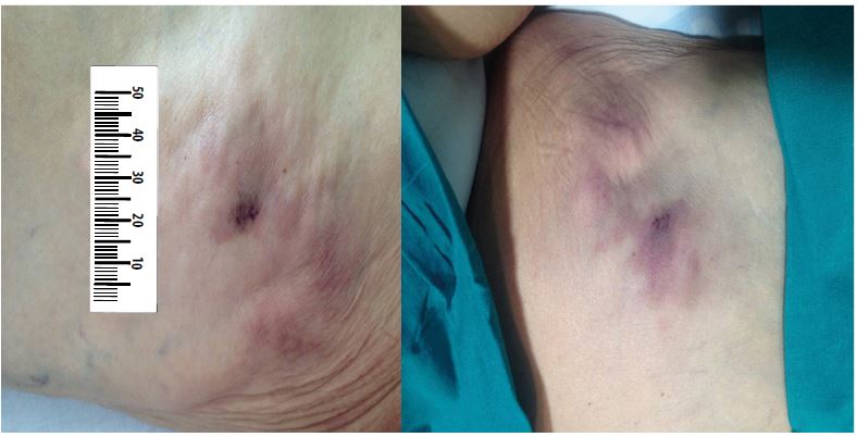 Subcutaneous, non-ulcerated and violaceous nodules on her left front and back thigh respectively, prior to the treatment.