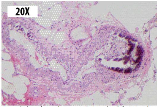 Skin biopsy: hematoxylin-eosin stain 20x. Dystrophic calcification in medium size arteries with intimal proliferation is observed at the hypodermis level.