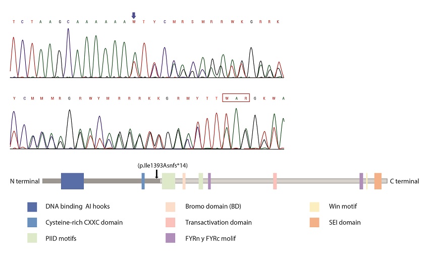 A. Location of reported KMT2A mutation: Electrophogram of exon 9 of the KMT2A gene showed duplication of adenine (blue arrow) at position 4177 c.4177dupA. This has a frameshift effect, generating a premature stop at codon 13 positions later (red box). B. Position at the protein level: The mutation leads to premature termination of the translation before the c-terminal region (black arrow) that contains the BD domain, transactivation domain and SET domain, as PHD motifs that are essential for gene recognition, transactivation and transformation associated with protein function. FRYN, FYRC, and Win motifs are not expressed either.